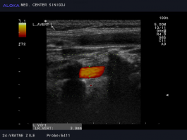 Ultrazvok vratnih žil - normalno široka leva vertebralna arterija